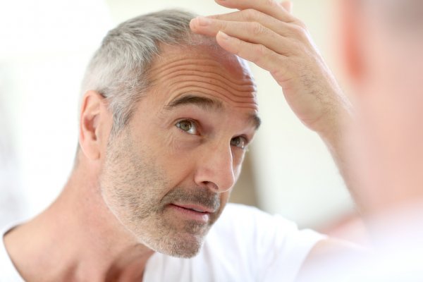 Edad en la que se estabiliza la alopecia androgénica