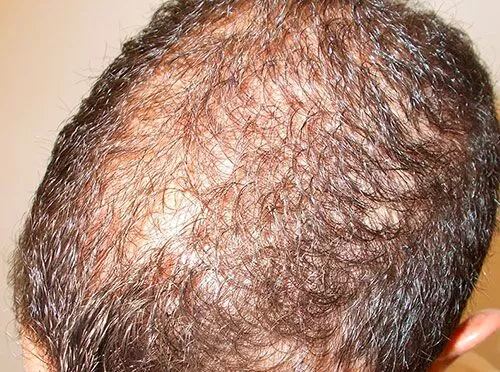 Alopecia androgenética