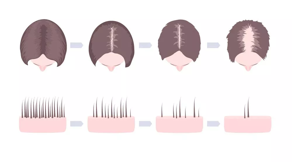 Alopecia androgénica en mujeres