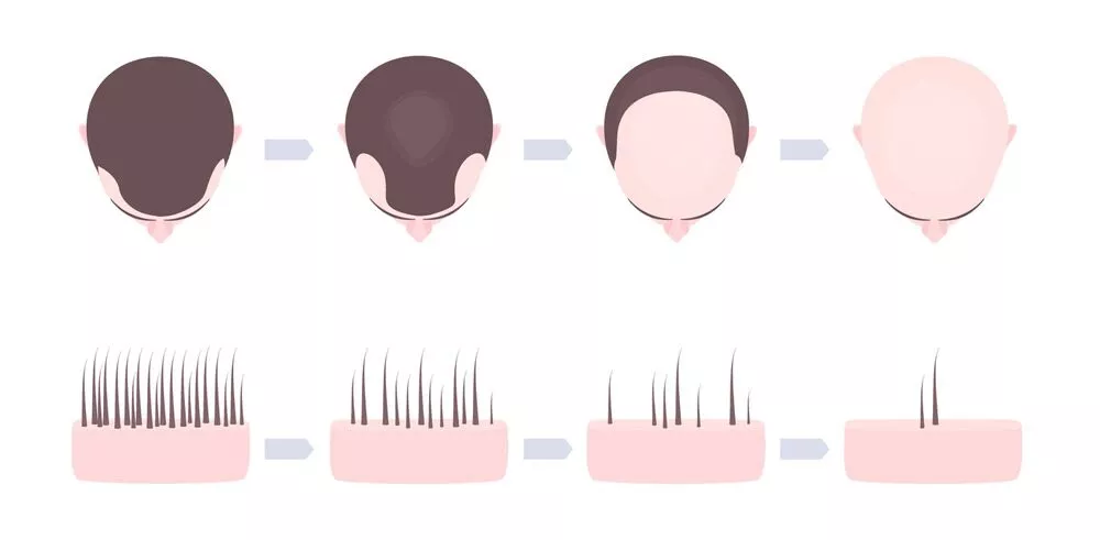 Alopecia androgenética