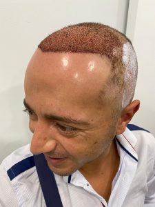 Injerto capilar después