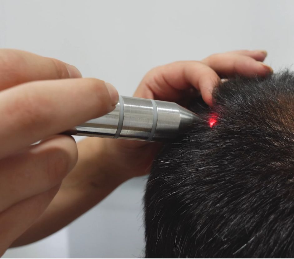 Laser capilar