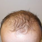 hombre con alopecia androgenética