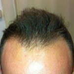 hombre con alopecia androgenética