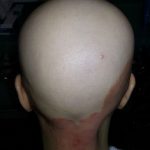hombre con alopecia areata