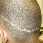 hombre con alopecia cicatrizal