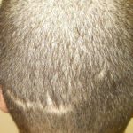 hombre con alopecia cicatrizal