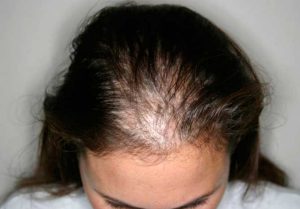 Mujer con alopecia difusa frontal fibrosante