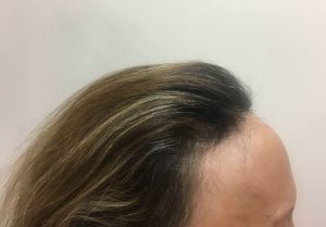 Mujer con alopecia frontal fibrosante