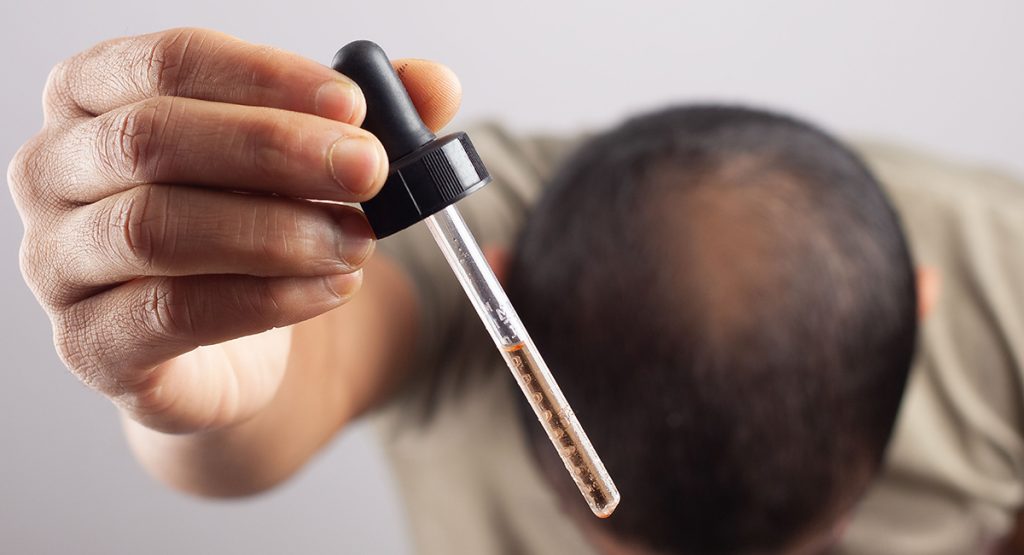 Principales presentaciones de minoxidil