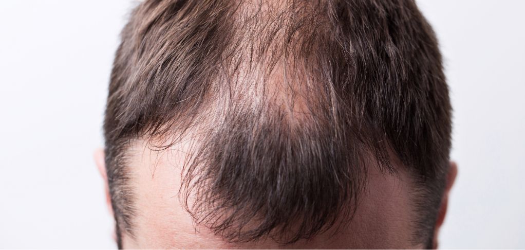 alopecia en hombre