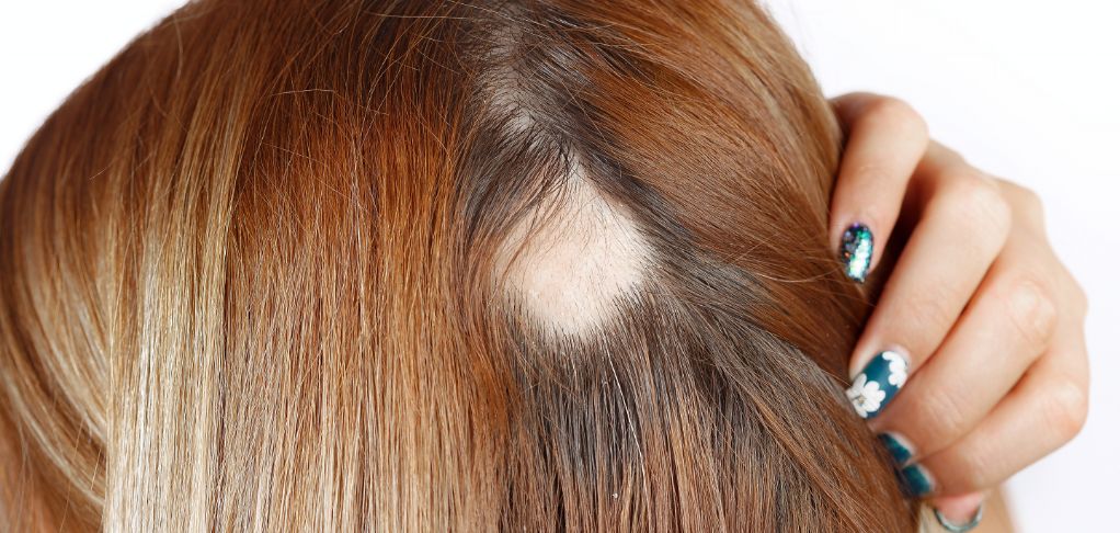alopecia areata en mujer