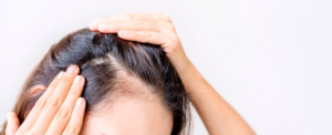 mujer enseñando su alopecia en el cuero cabelludo