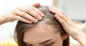 Mujer con alopecia androgénica