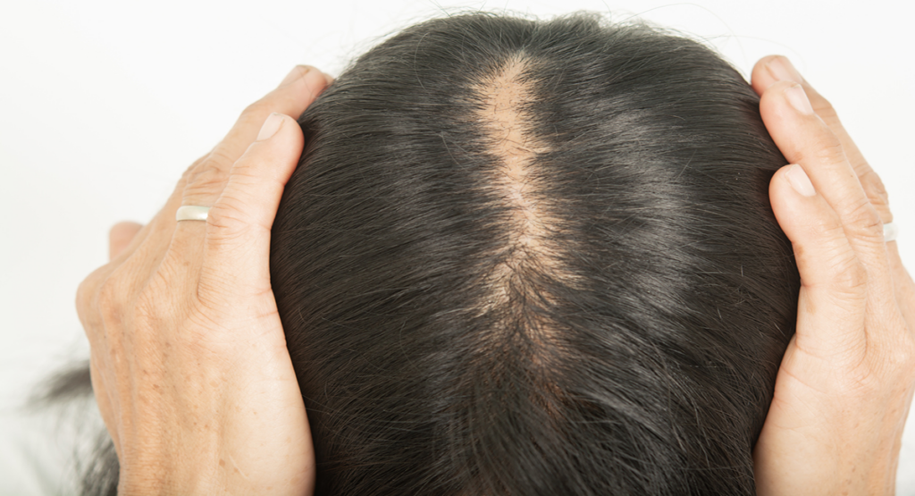 mujer con caso de alopecia en el cuero cabelludo