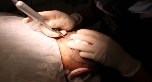 Médico realizando un injerto capilar en IMD