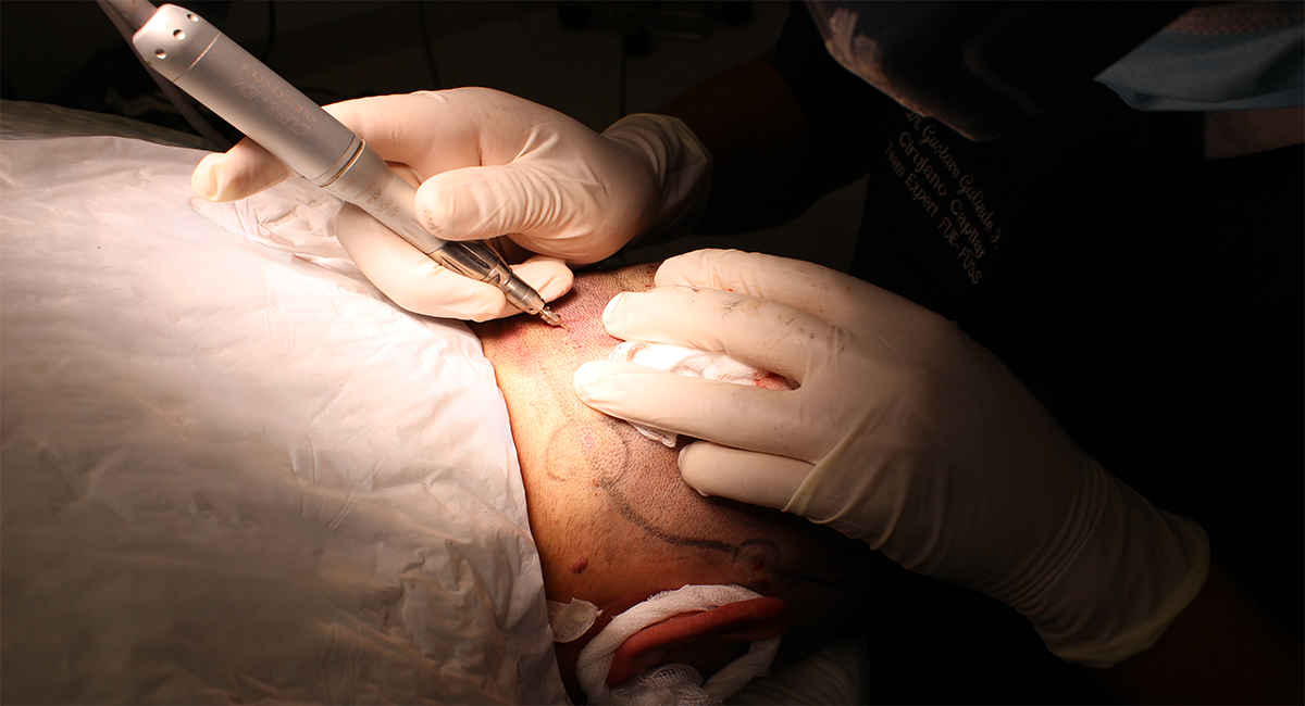 Médico realizando un injerto capilar en IMD