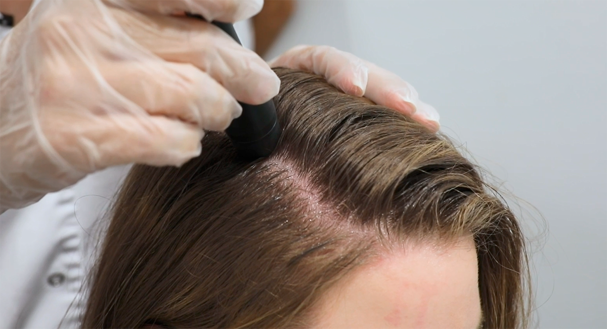 Médico realizando un estudio capilar en el cabello de una mujer