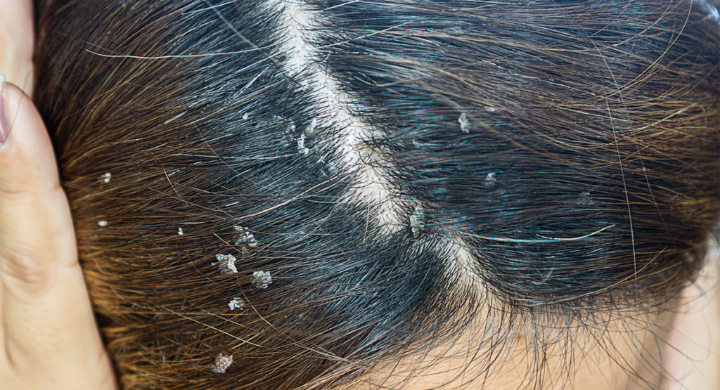 dermatitis seborreica en cuero cabelludo mujer