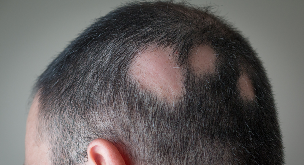 hombre con alopecia areata