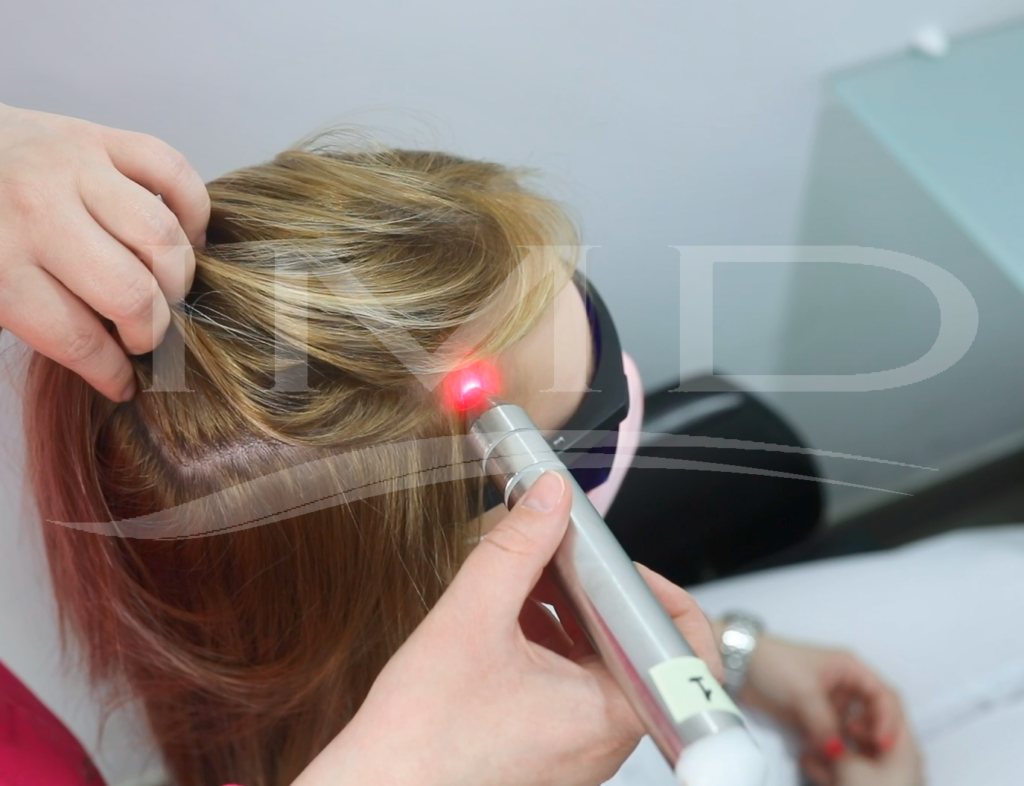 Mujer le realizan un tratamiento de láser en el cuero cabelludo.