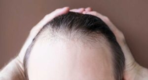 Alopecia Frontal Fibrosante (AFF) en mujer