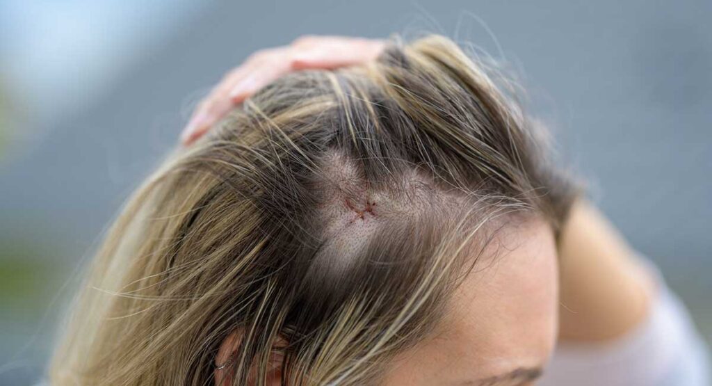 mujer con una cicatriz en la cabeza