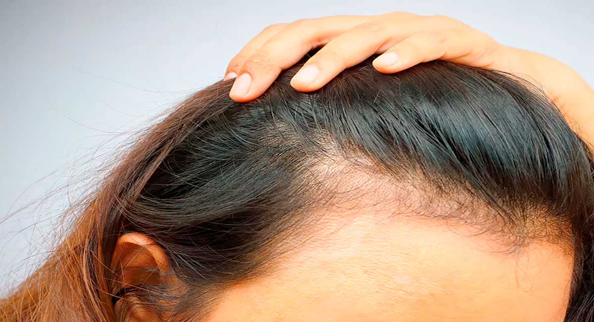 mujer con alopecia frontal fibrosante