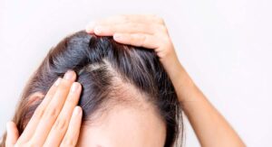 mujer enseñando su alopecia en el cuero cabelludo