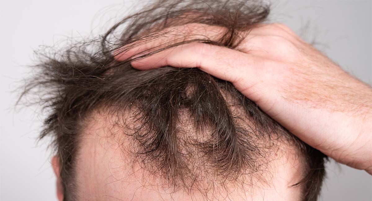 Hombre calvo que muestra pérdida de cabello en la coronilla de su cabeza