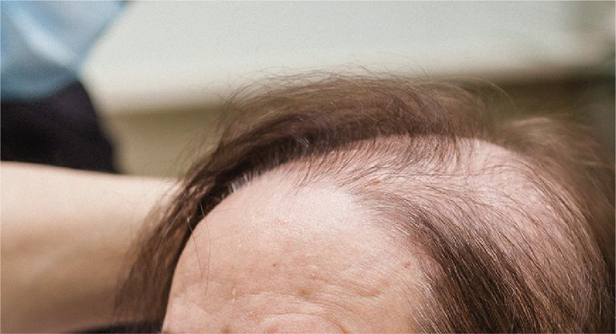 Descubre tu grado de alopecia