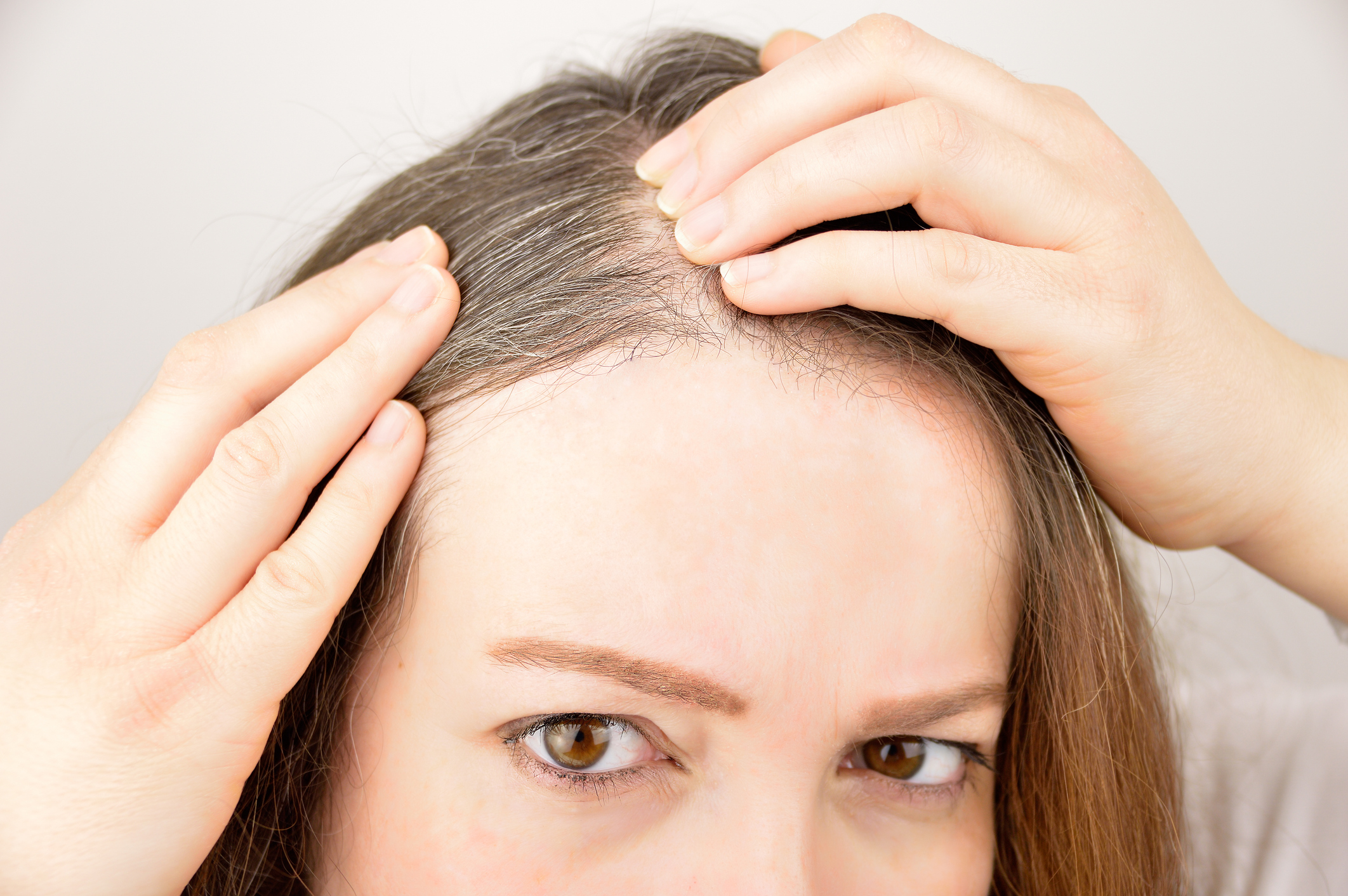 Alopecia-Femenina-como-evitar-la-caida-el-pelo