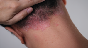 Dermatitis seborreica