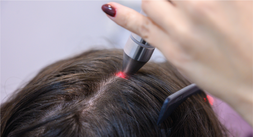 El láser capilar como tratamiento para frenar la alopecia