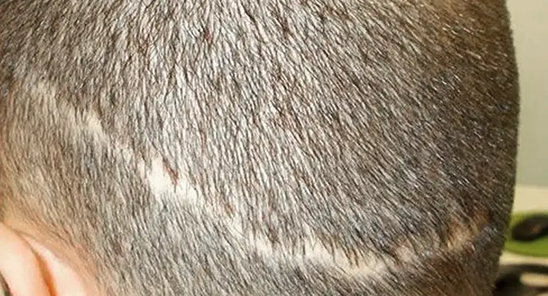 alopecia cicatrizal