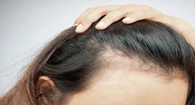 alopecia fibrosante