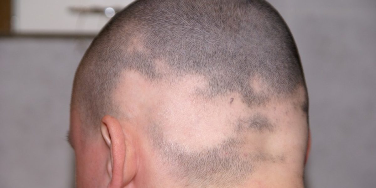 La alopecia con mas preguntas