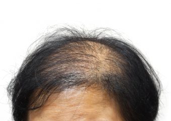 61983902 - asian female head with hair loss