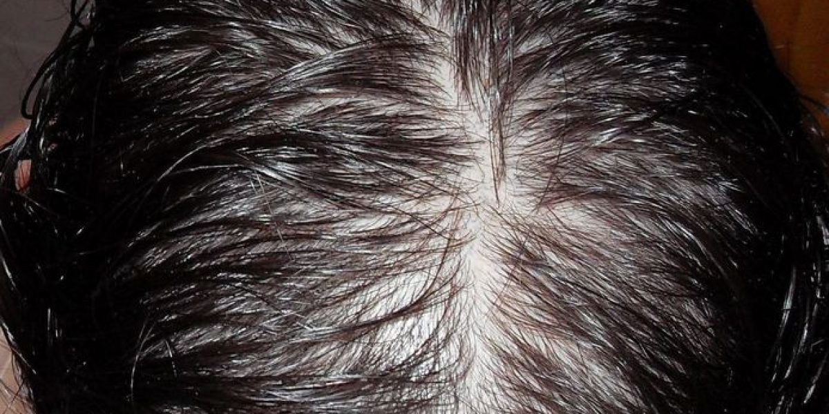 ovario poliquistico y su relacion con la alopecia femenina