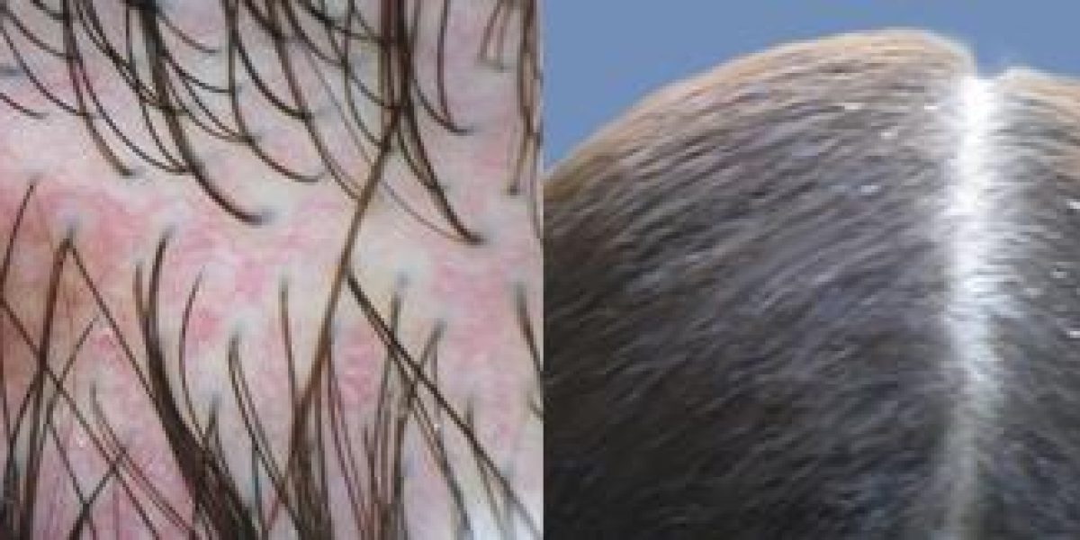 problemas-capilares-tratamientos-imd-dermatologico