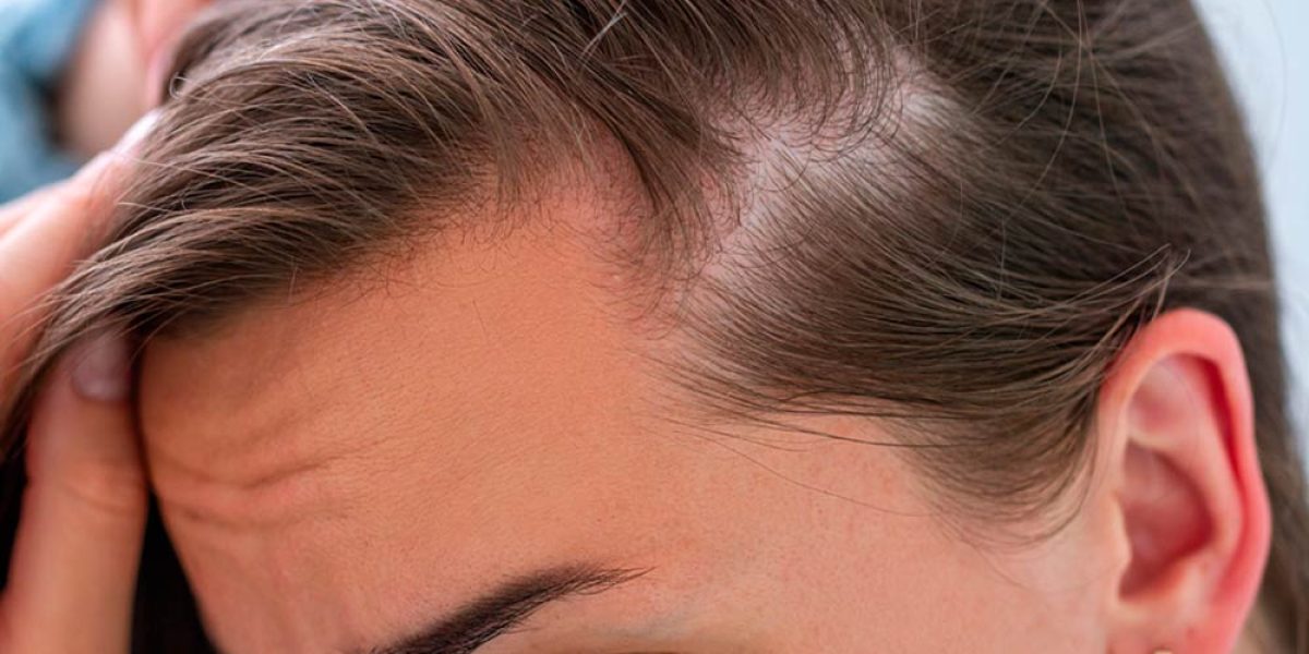 prevencion capilar puede salvar tu cabello